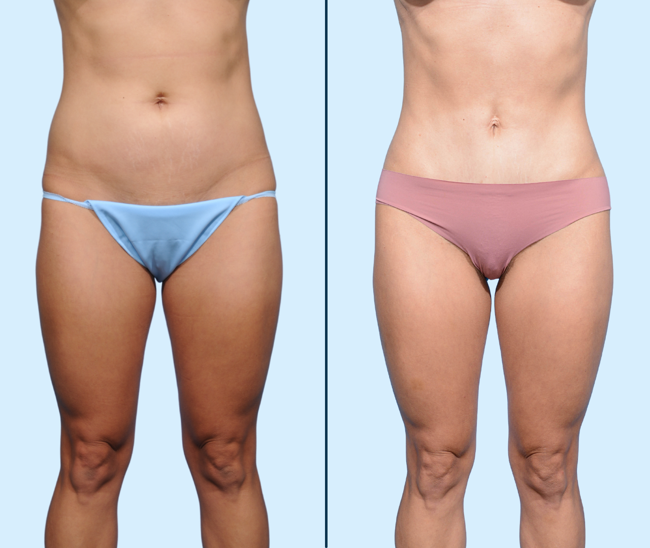 Case 17- Front View- Before and After Tiny Tummy Tuck with Umbilical Float and Ab Etching by Dr. John Burns