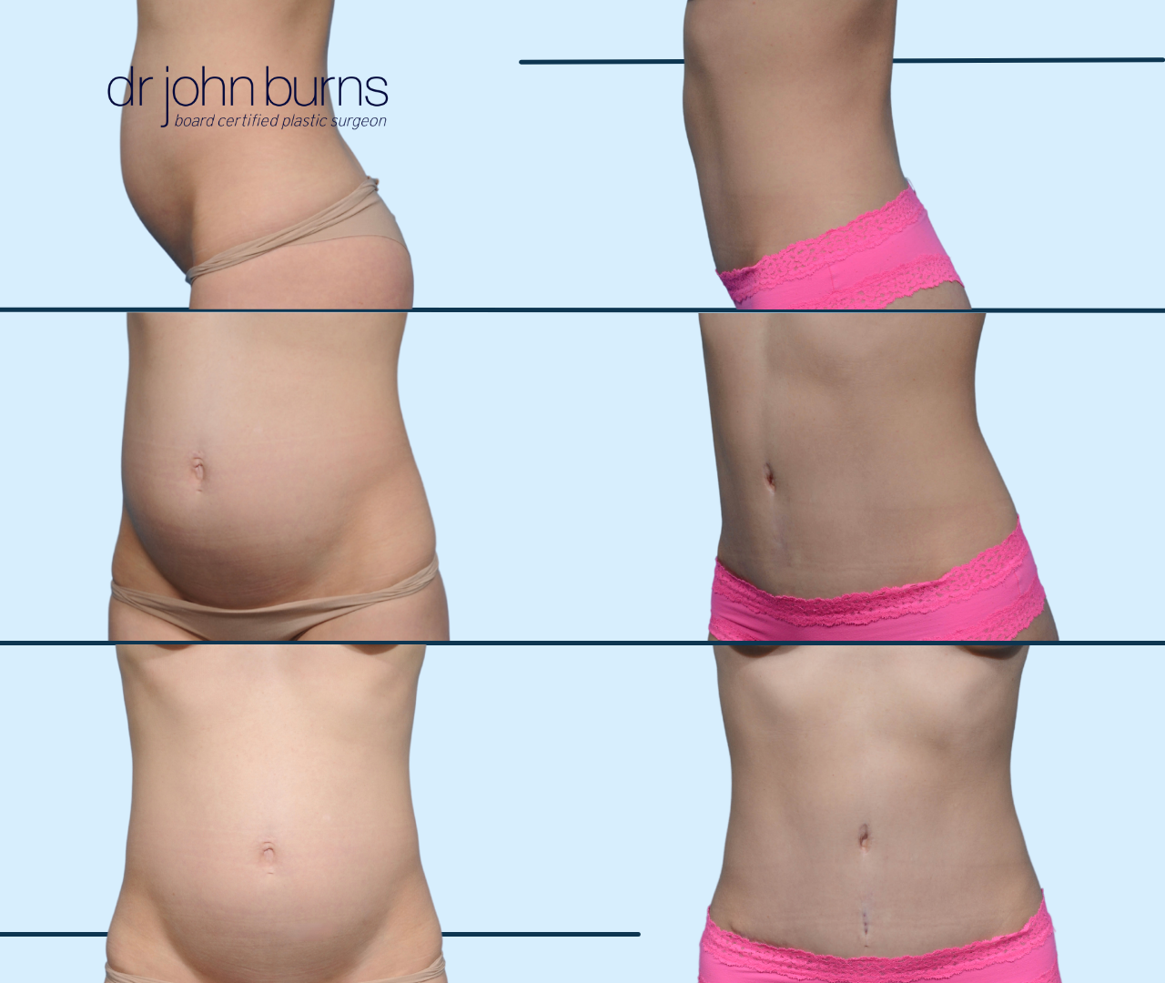 Case 18- Before & After Mini Tummy Tuck with Liposuction by Dr. John Burns