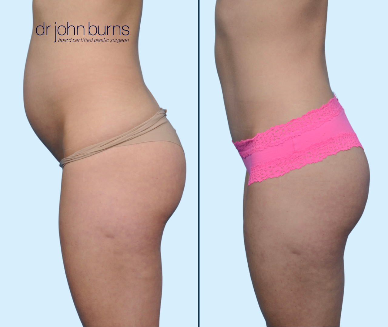 Case 18- Profile View- Before & After Mini Tummy Tuck with Liposuction by Dr. John Burns