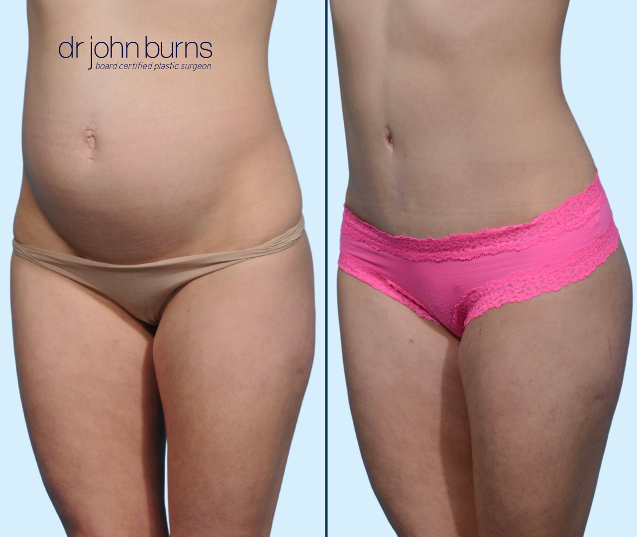 Case 18- 45 Degree View- Before & After Mini Tummy Tuck with Liposuction by Dr. John Burns