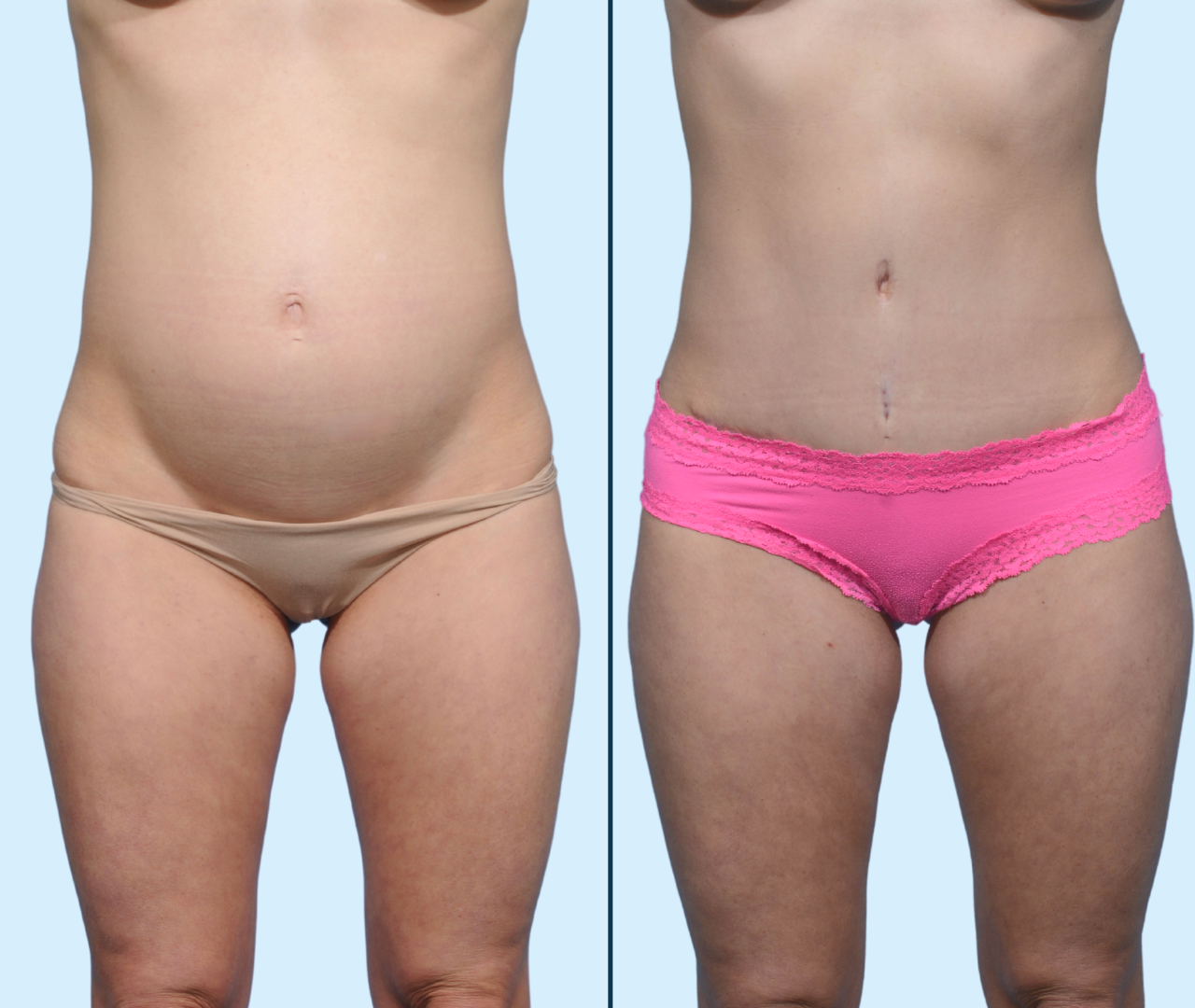 Case 18- Front View- Before & After Mini Tummy Tuck with Liposuction by Dr. John Burns