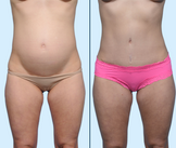 Diastasis Recti Repair- Dallas Tummy Tuck by Dr. John Burns in Dallas, TX