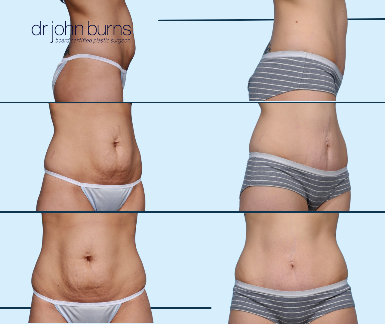 Case 19- Before & After Tummy Tuck with Lipo 360, Dallas, Texas