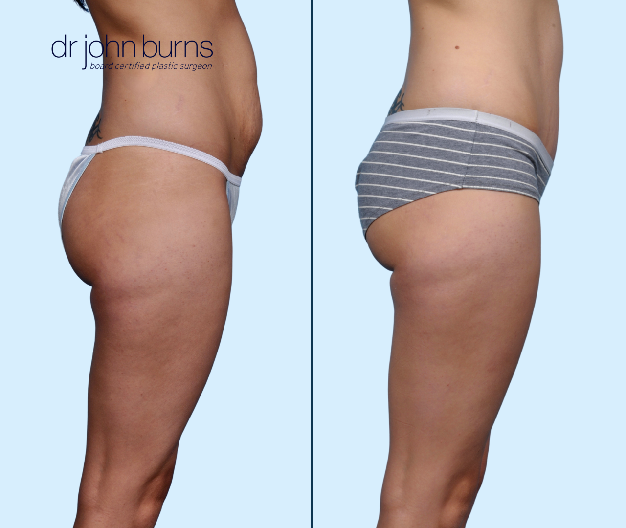 Case 19- Profile View-Before & After Tummy Tuck with Lipo 360, Dallas, Texas