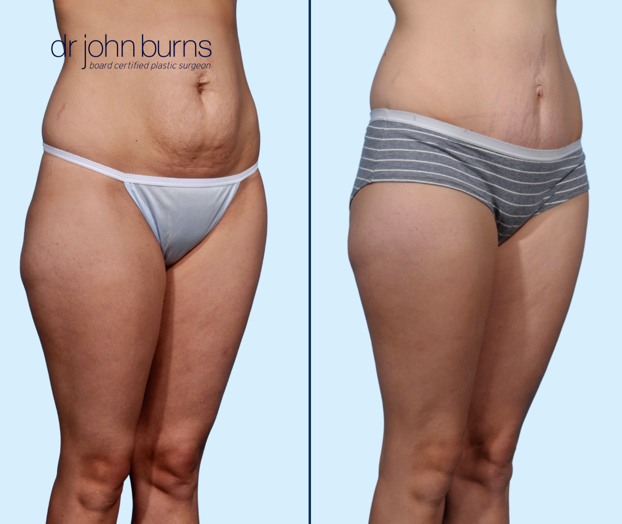 Case 19- 45 Degree View-Before & After Tummy Tuck with Lipo 360, Dallas, Texas