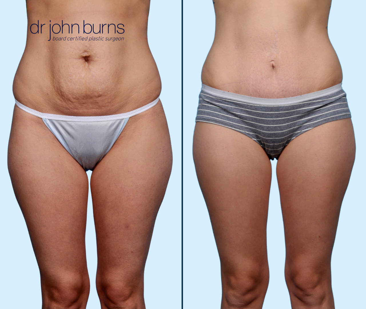 Case 19- Front View-Before & After Tummy Tuck with Lipo 360, Dallas, Texas