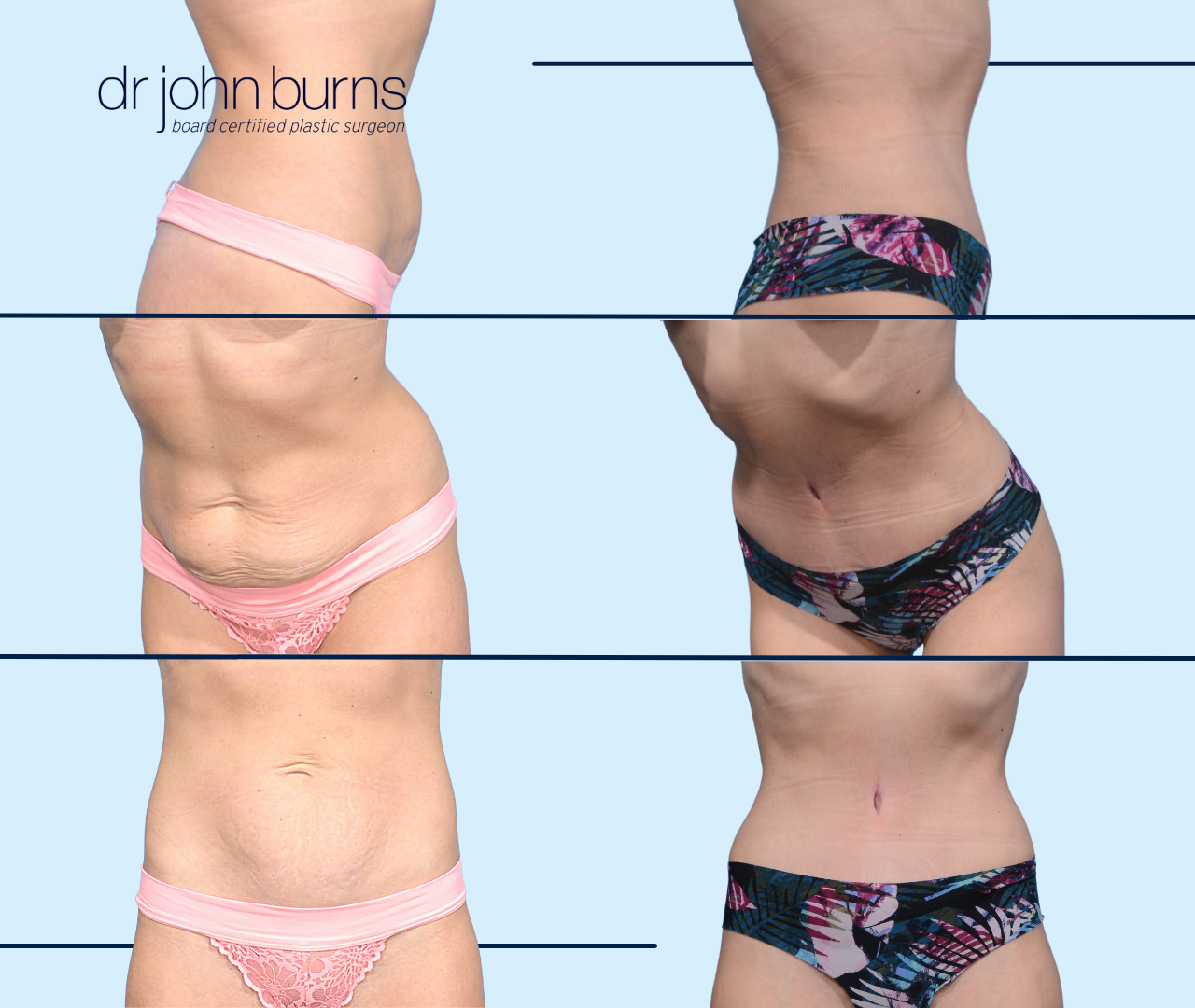 Case 20- Before & After Dallas Tummy Tuck with Lipo 360 by Dr. John Burns