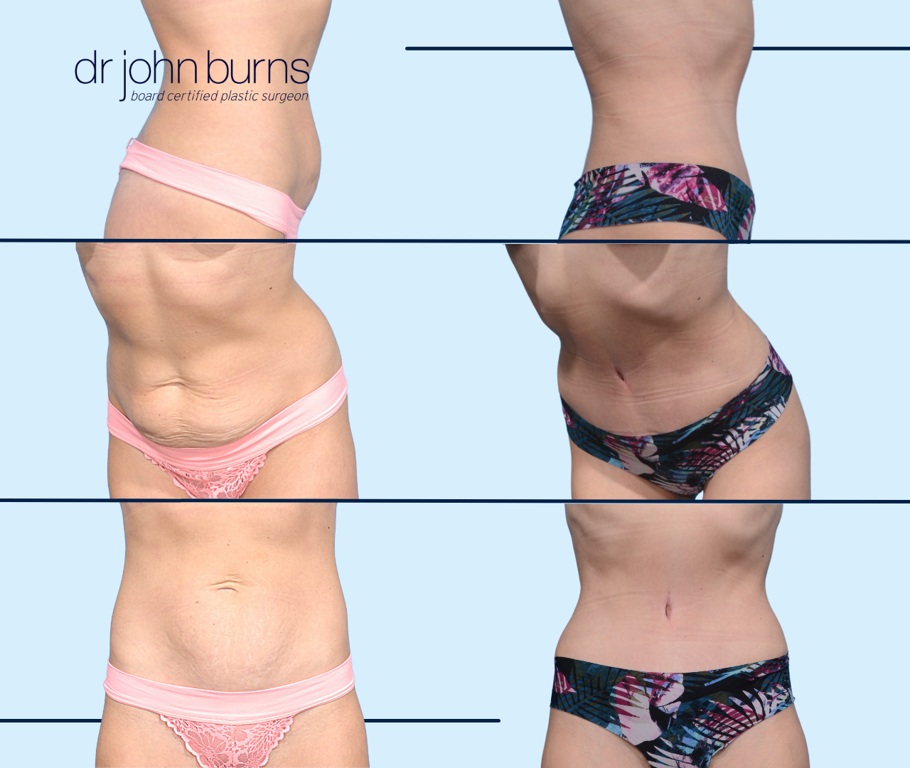 How To Tell If You Need Lipo or A Tummy Tuck- Dr. John Burns MD – Dr John  Burns