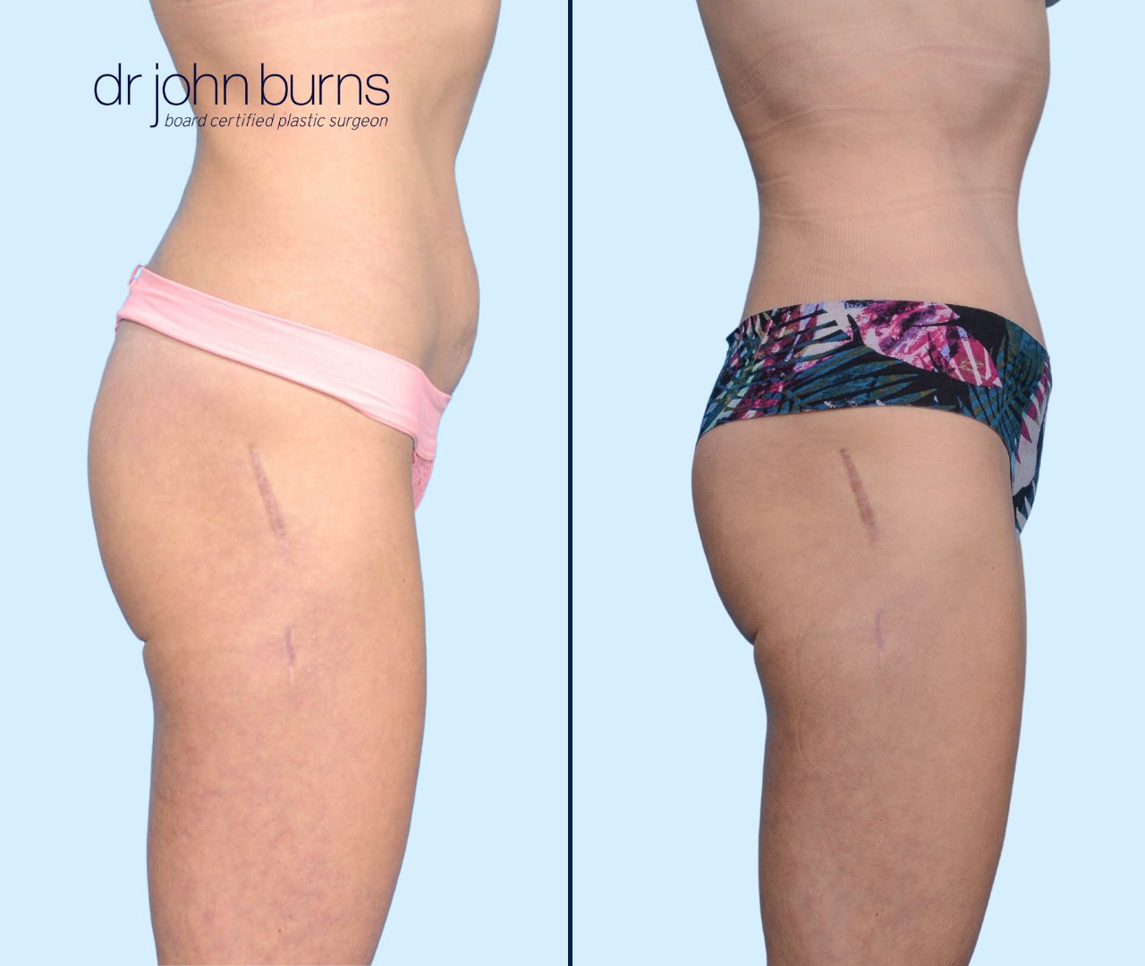 Case 20- Profile View- Before & After Dallas Tummy Tuck with Lipo 360 by Dr. John Burns