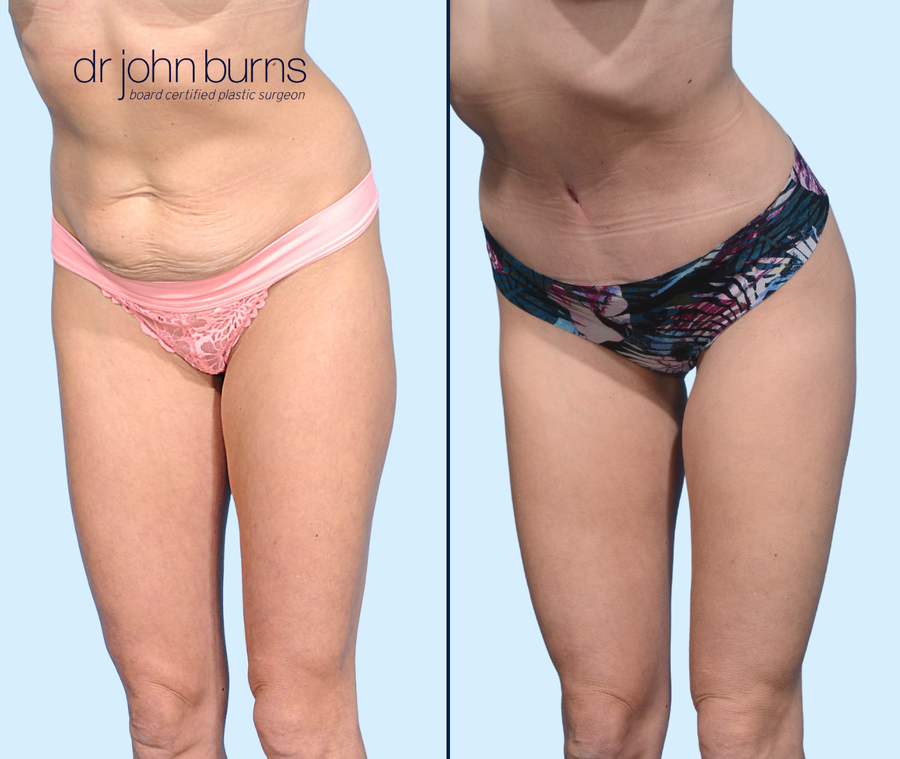 Dallas Tummy Tuck Before & After Results by Dr. John Burns – Dr John Burns