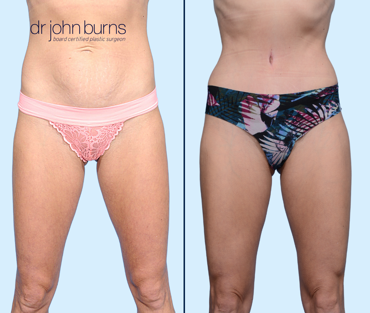 Case 20- Front View- Before & After Dallas Tummy Tuck with Lipo 360 by Dr. John Burns