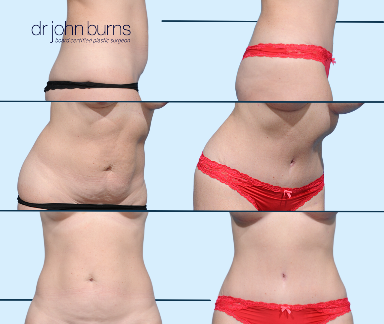 Case 21- Before & After Dallas Mini Tummy Tuck with Lipo by Dr. John Burns