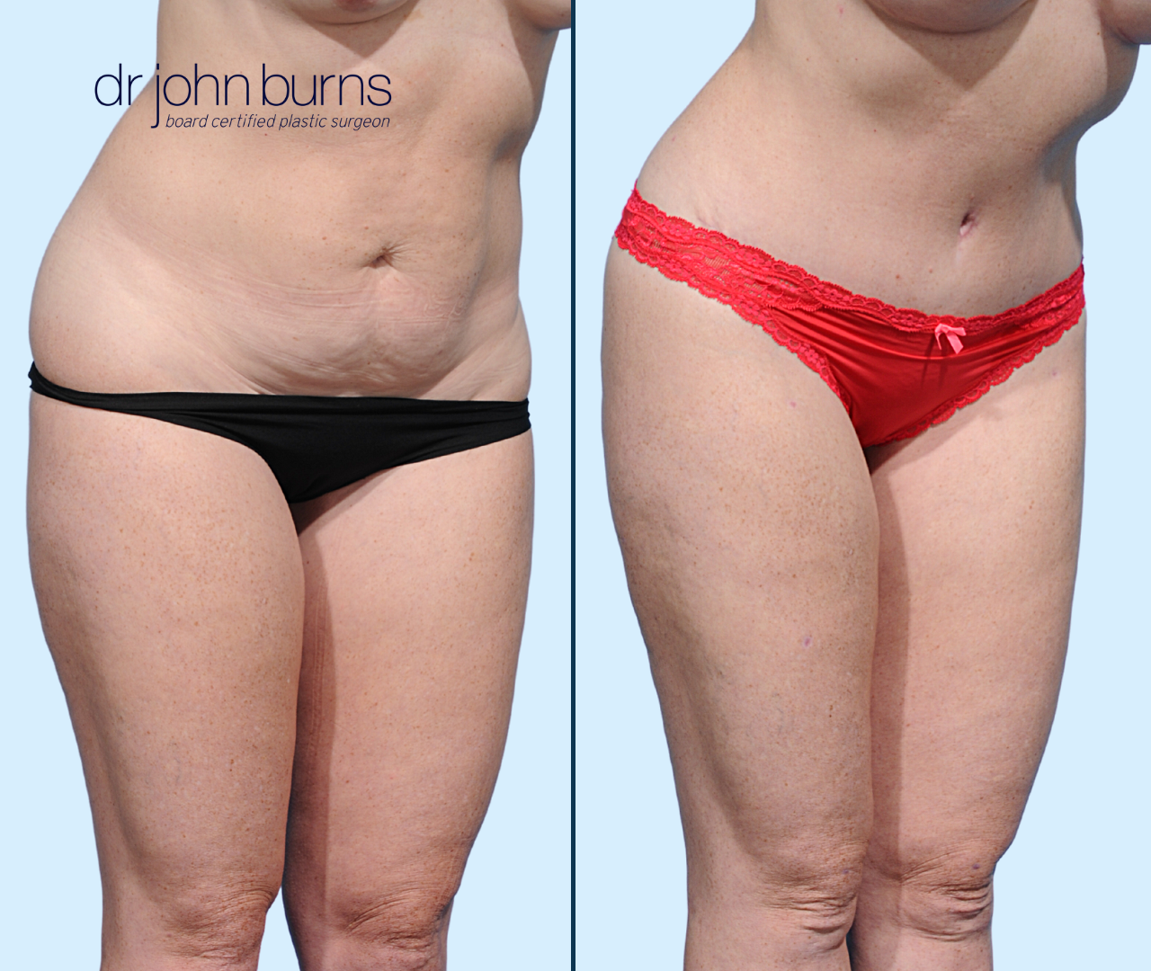 Case 21- 45 Degree View- Before & After Dallas Mini Tummy Tuck with Lipo by Dr. John Burns