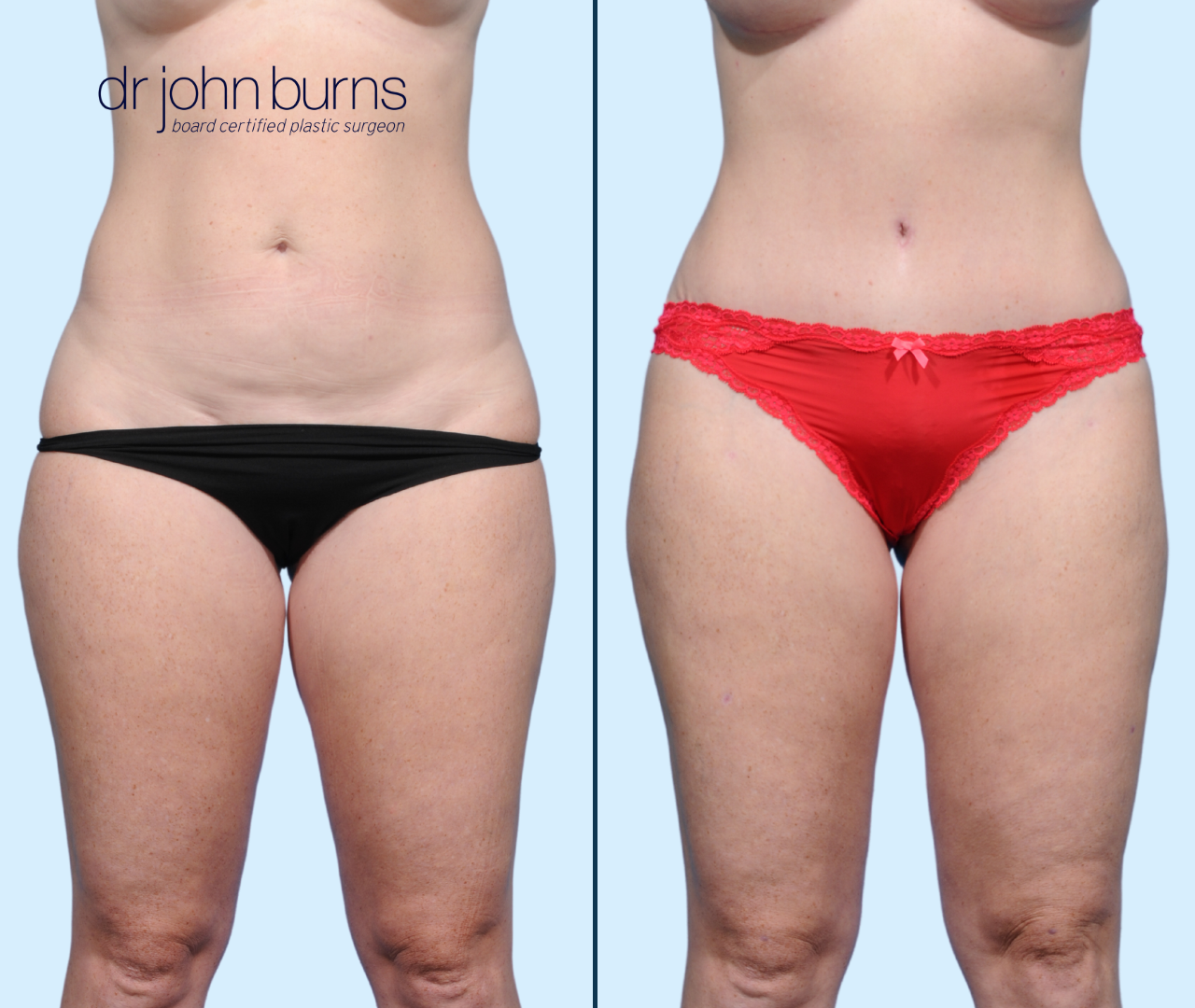 Case 21- Front View- Before & After Dallas Mini Tummy Tuck with Lipo by Dr. John Burns