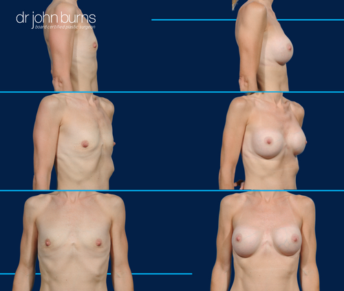 Before & After Breast Augmentation- Dallas Plastic Surgeon Dr. John Burns