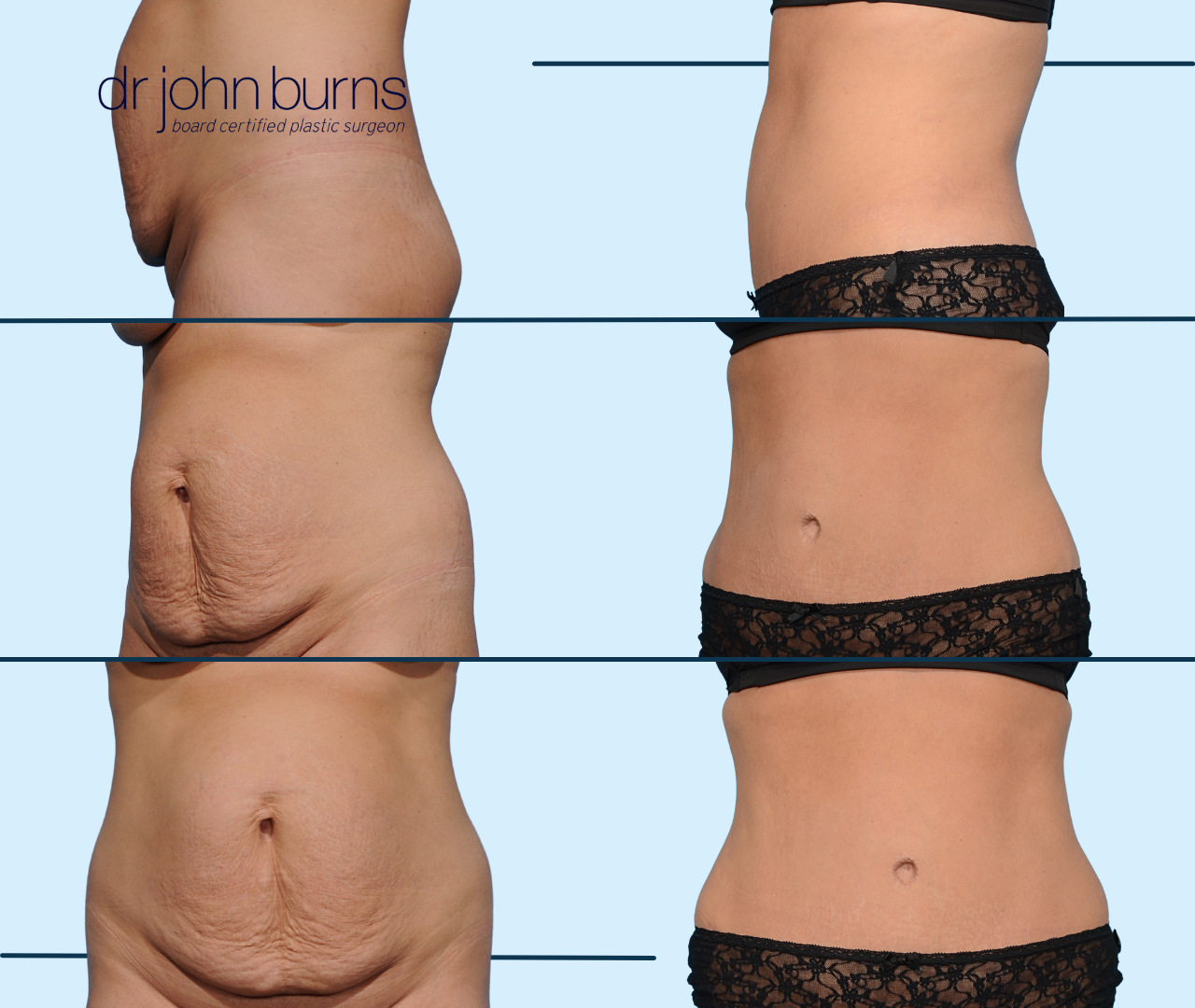 Case 22- Before & After Standard Tummy Tuck by Dallas Plastic Surgeon, Dr. John Burns