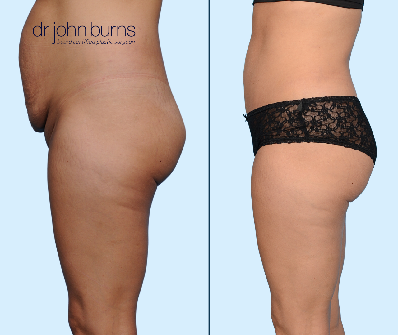 Case 22-Profile View-Before & After Standard Tummy Tuck by Dallas Plastic Surgeon, Dr. John Burns