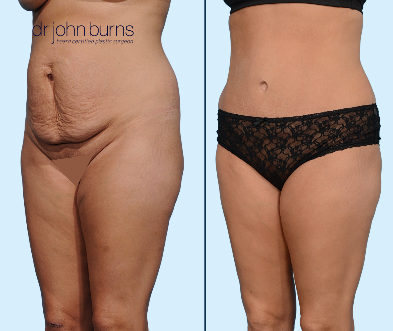 Case 22-45 Degree View-Before & After Standard Tummy Tuck by Dallas Plastic Surgeon, Dr. John Burns