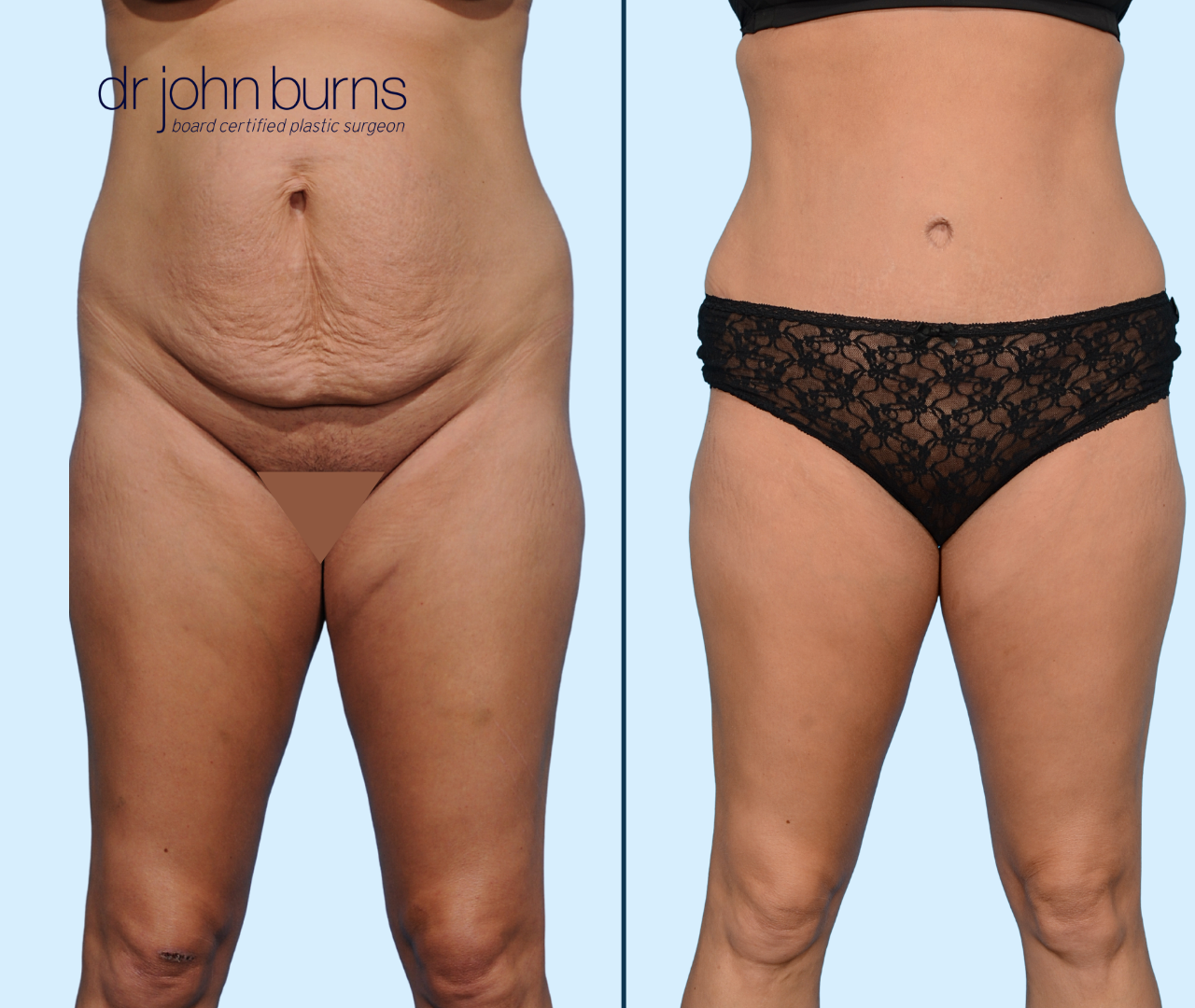 Case 22-Front View-Before & After Standard Tummy Tuck by Dallas Plastic Surgeon, Dr. John Burns