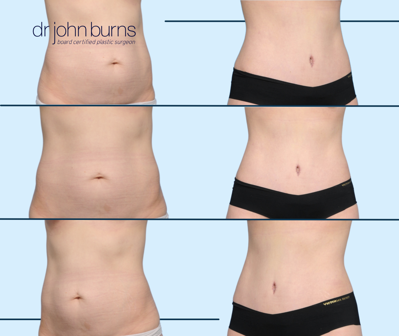 Case 23- Before & After Tummy Tuck with Lipo 360 by Dr. John Burns