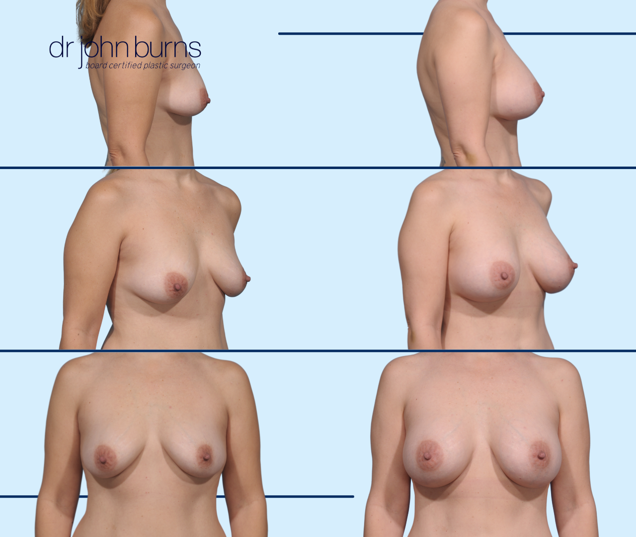 3 sets of before and after silicone gel breast implants on a caucasian woman