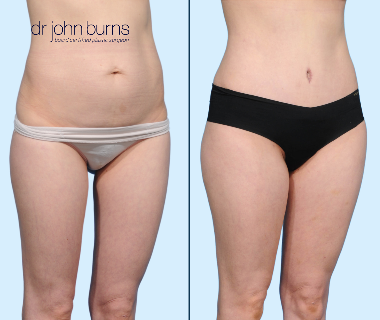 Case 23- R 45 Degree View-Before & After Tummy Tuck with Lipo 360 by Dr. John Burns