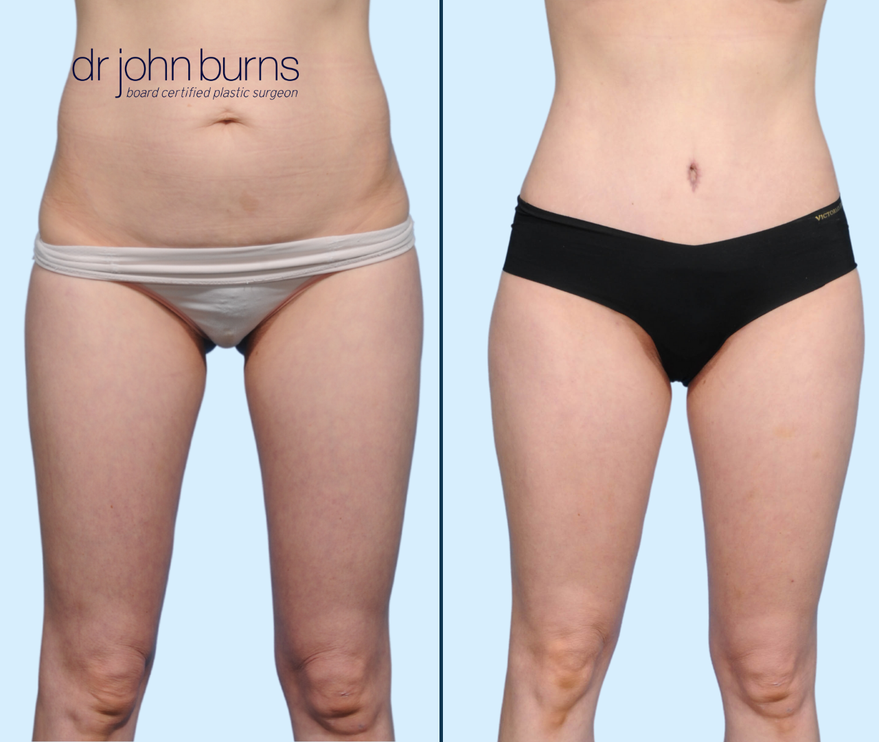 Case 23- Front View-Before & After Tummy Tuck with Lipo 360 by Dr. John Burns