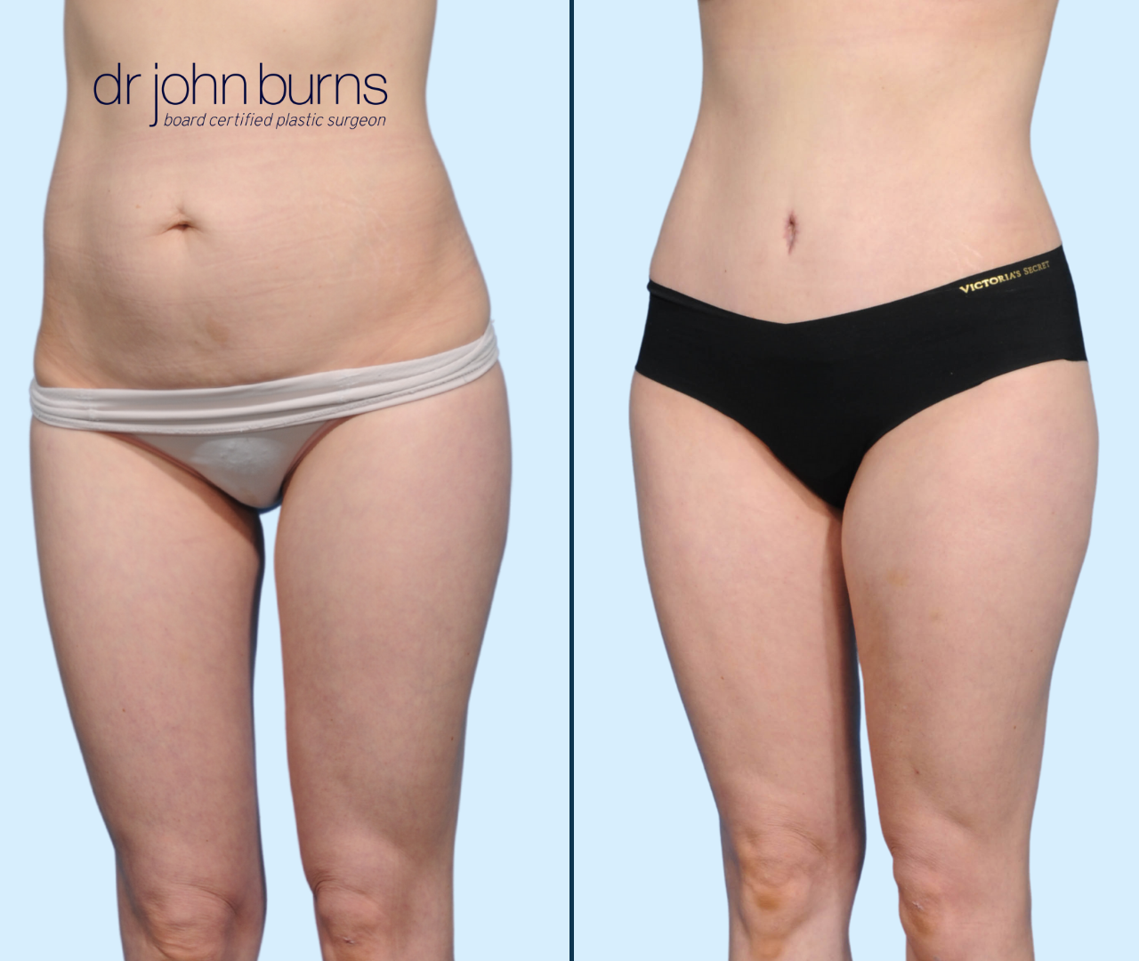 Case 23- L 45 Degree View-Before & After Tummy Tuck with Lipo 360 by Dr. John Burns