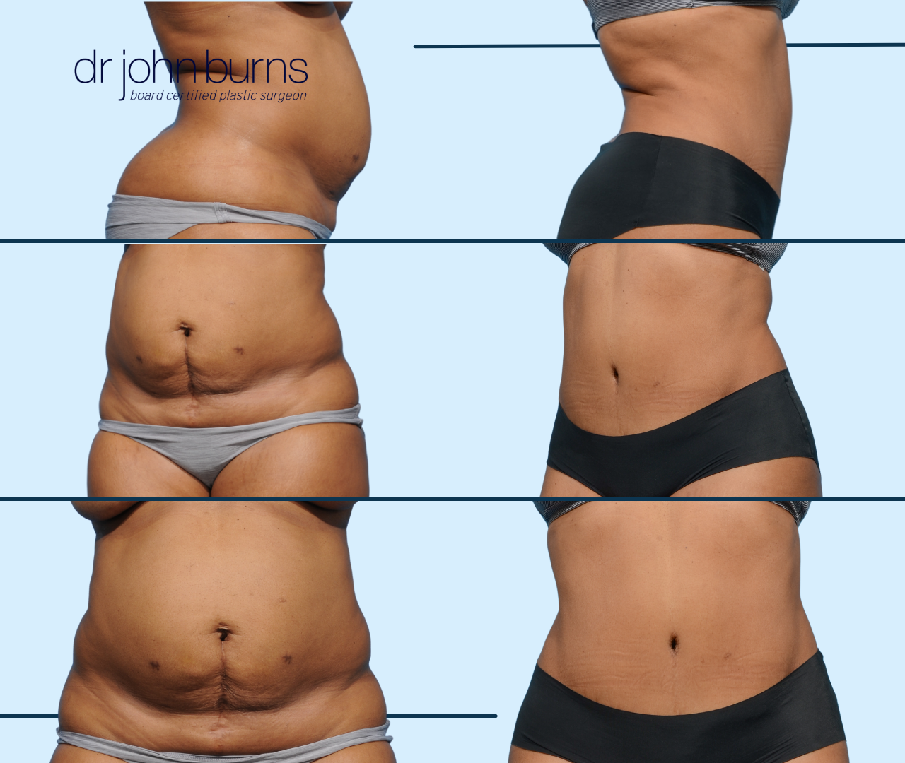 Case 24- Before & After Full Tummy Tuck with Lipo 360 by Dr. John Burns
