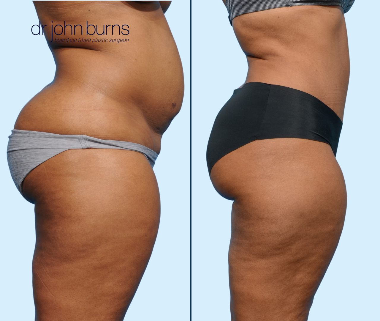 Case 24- Profile View- Before & After Full Tummy Tuck with Lipo 360 by Dr. John Burns