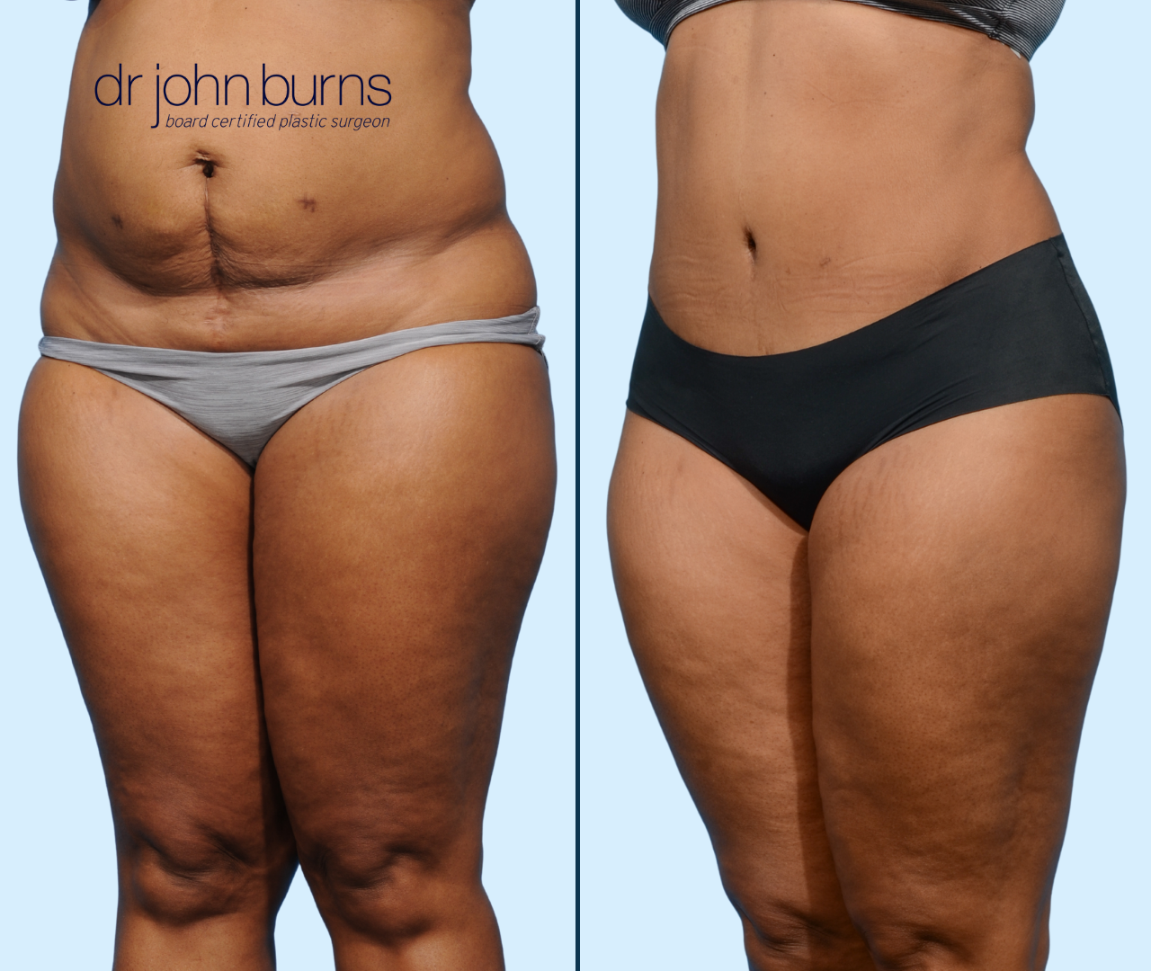 Case 24- 45 Degree View- Before & After Full Tummy Tuck with Lipo 360 by Dr. John Burns