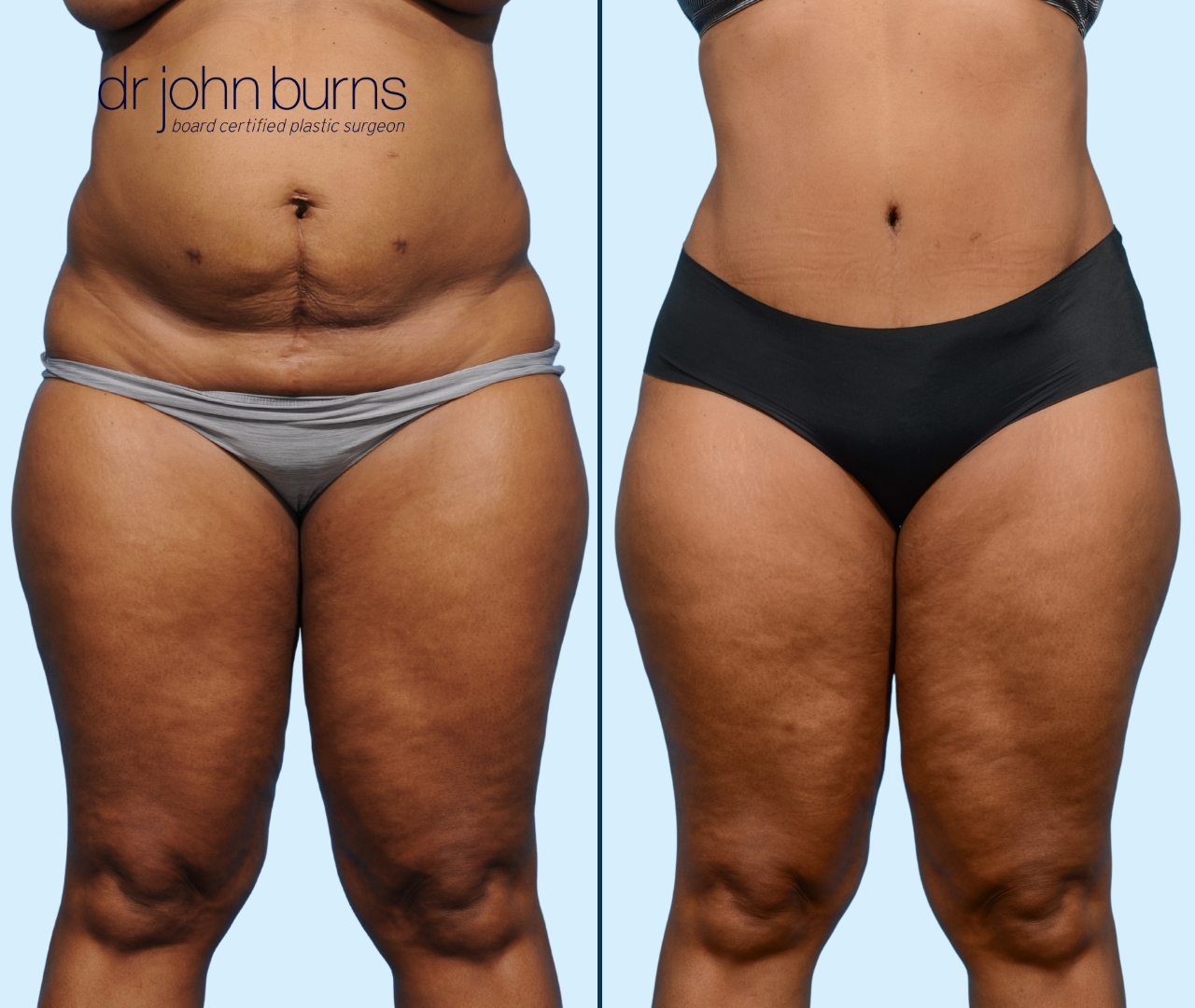 Case 24- Front View- Before & After Full Tummy Tuck with Lipo 360 by Dr. John Burns