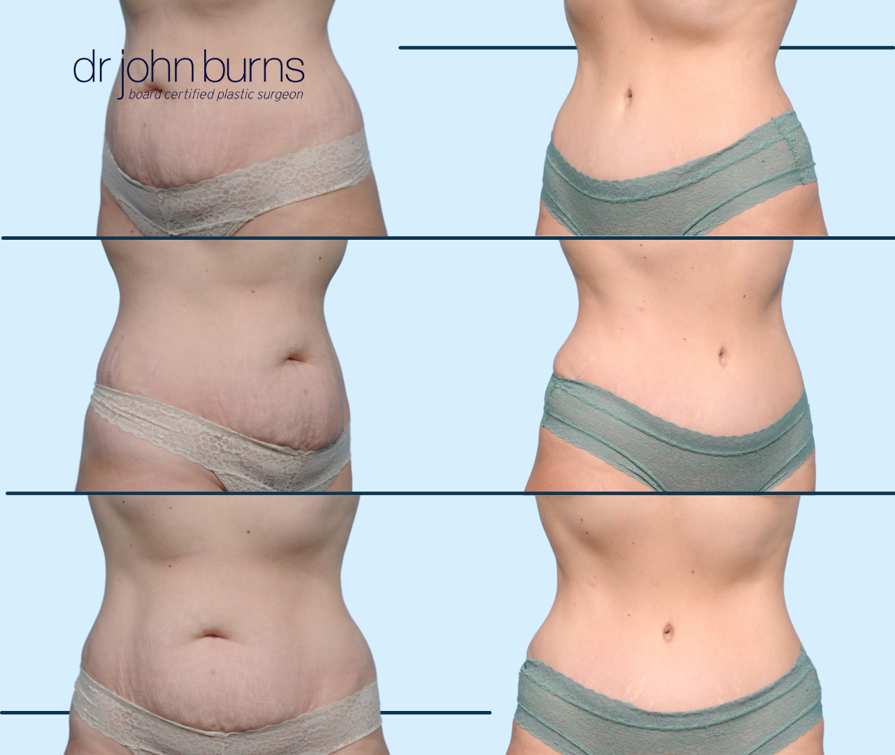 Case 25- Before & After Full Tummy Tuck with Lipo 360, Dallas, Texas
