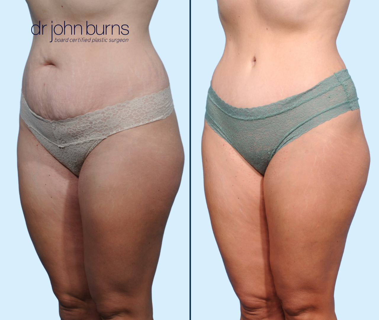 Case 25- L 45 Degree View- Before & After Full Tummy Tuck with Lipo 360, Dallas, Texas