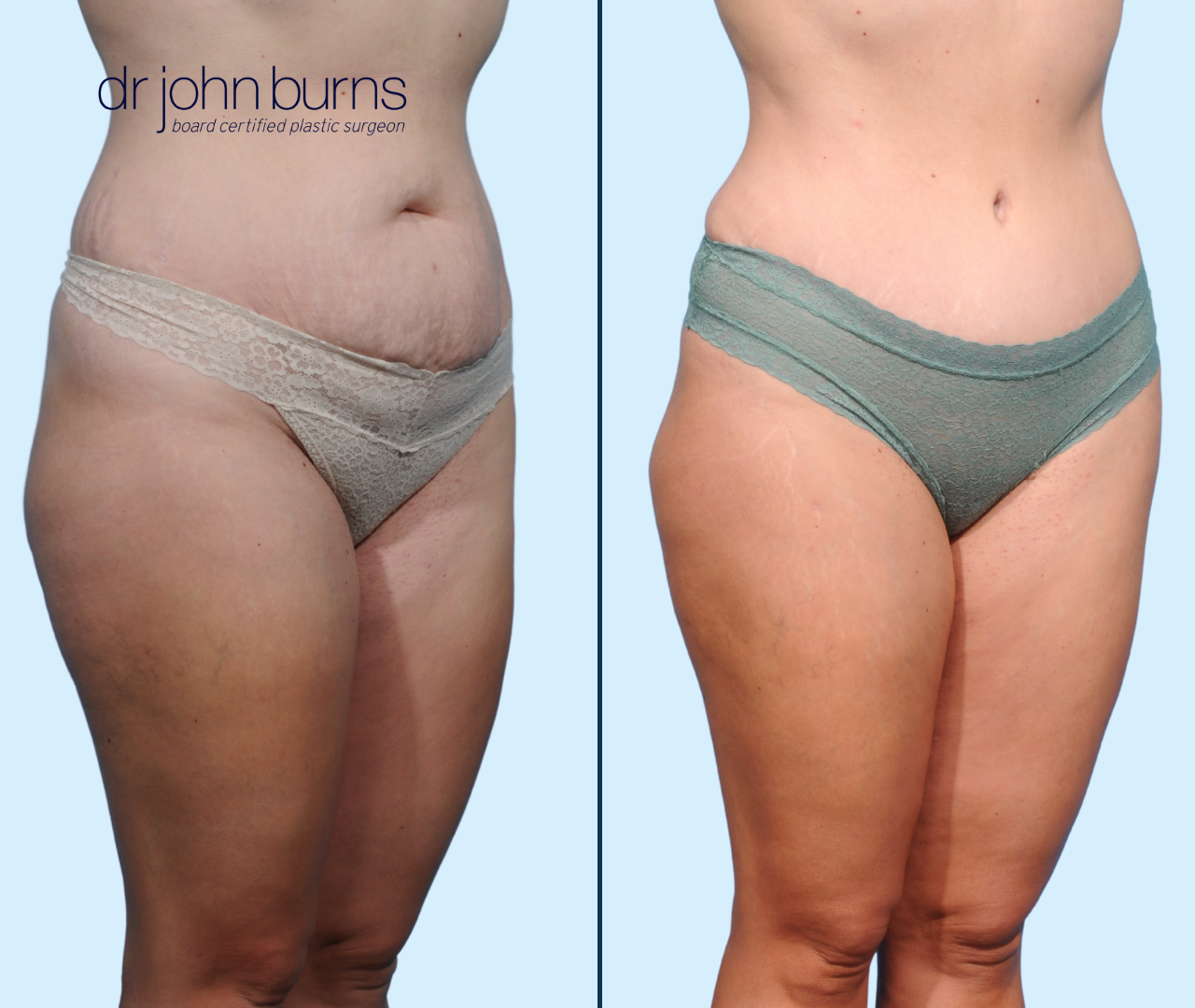 Case 25- R 45 Degree View- Before & After Full Tummy Tuck with Lipo 360, Dallas, Texas