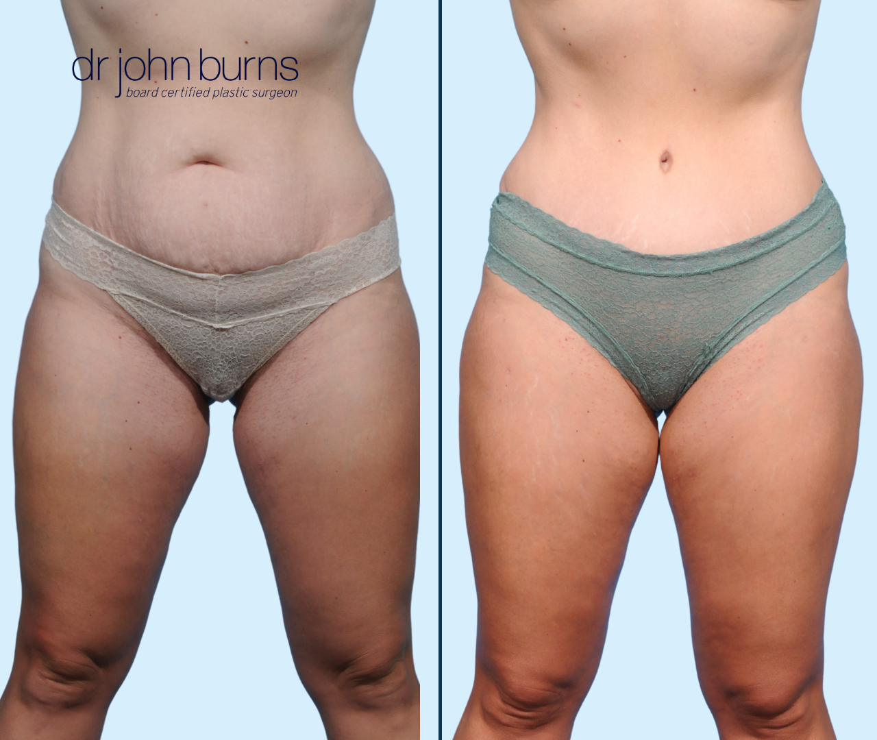 Case 25- Front View- Before & After Full Tummy Tuck with Lipo 360, Dallas, Texas