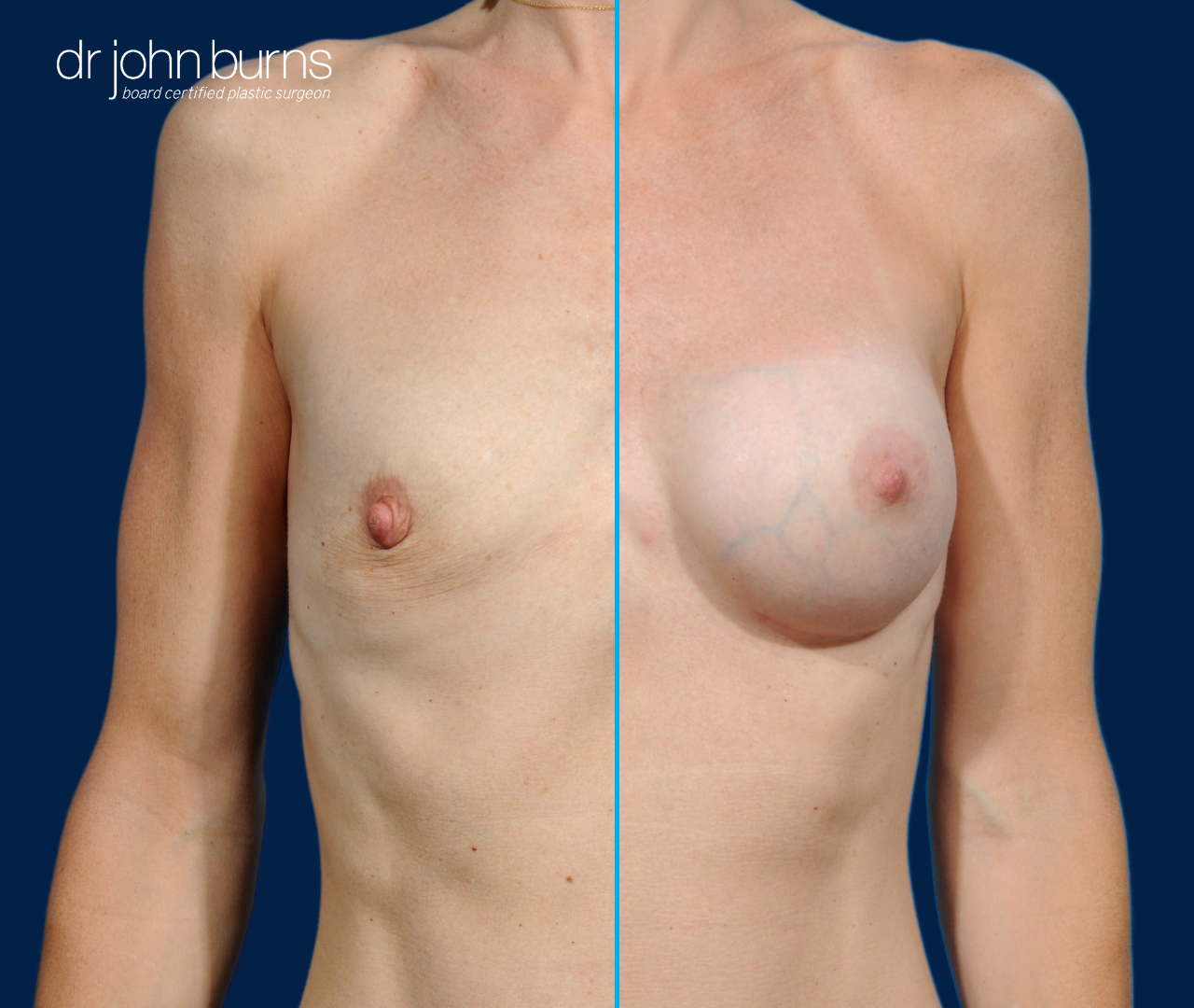 before and after breast implants- Dallas, Texas- Dr. John Burns