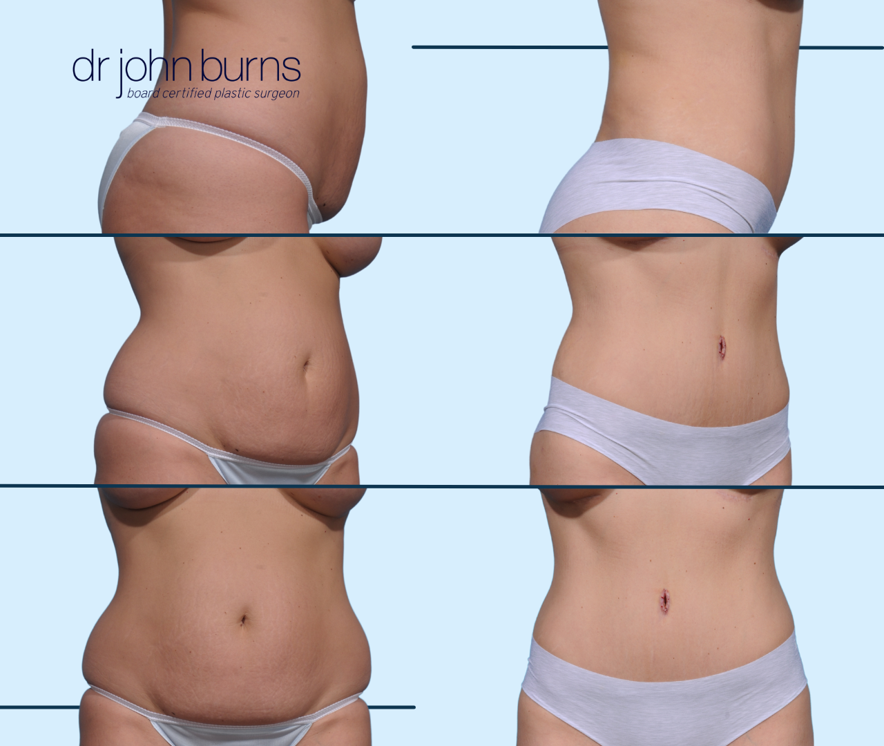 Case 26- Before & After Full Tummy Tuck with Lipo by Dallas Plastic Surgeon, Dr. John Burns