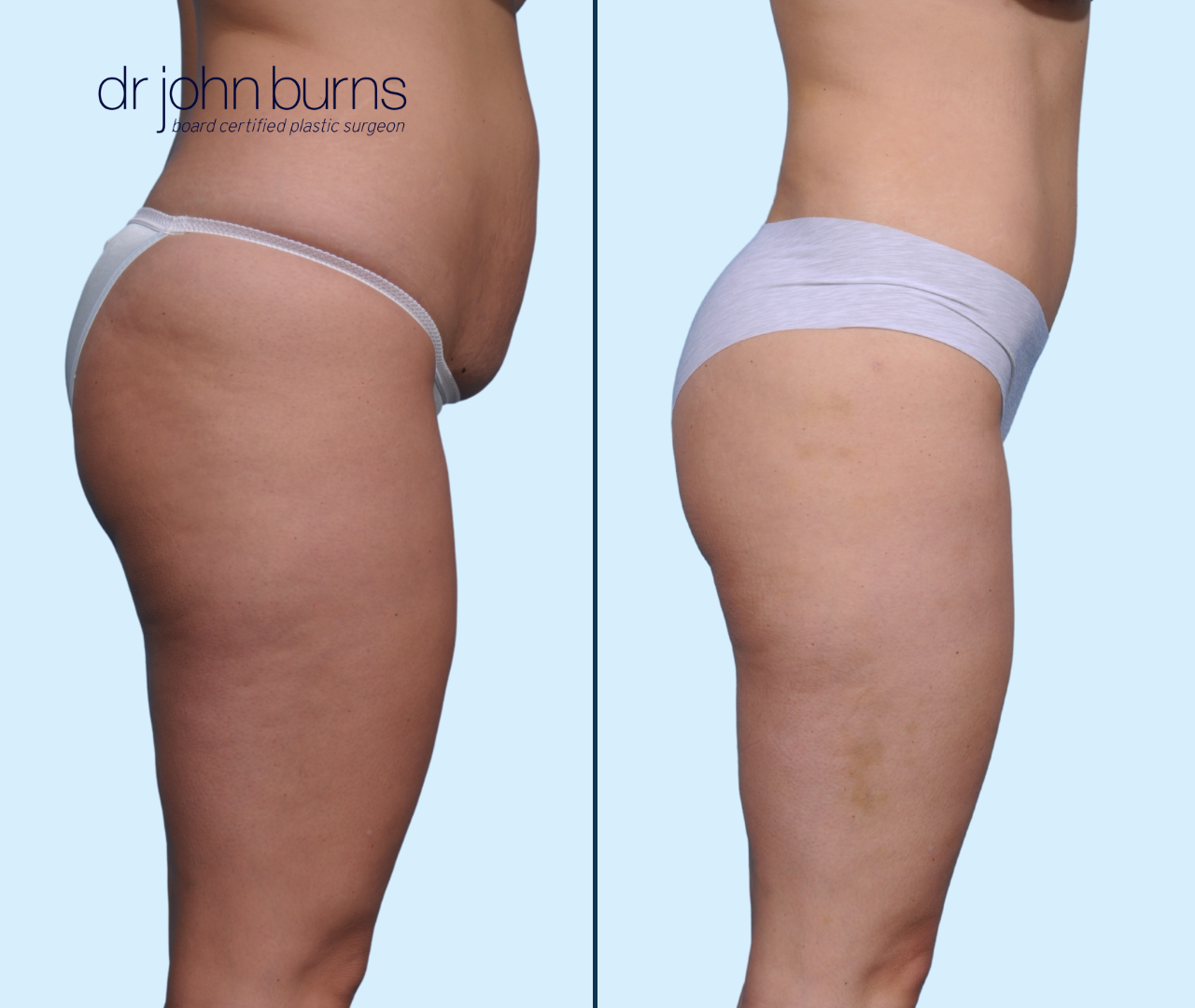 Case 26- Profile View- Before & After Full Tummy Tuck with Lipo by Dallas Plastic Surgeon, Dr. John Burns