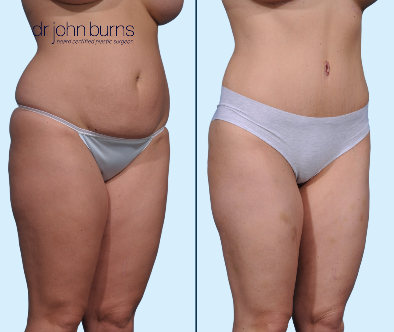 Case 26- 45 Degree View- Before & After Full Tummy Tuck with Lipo by Dallas Plastic Surgeon, Dr. John Burns