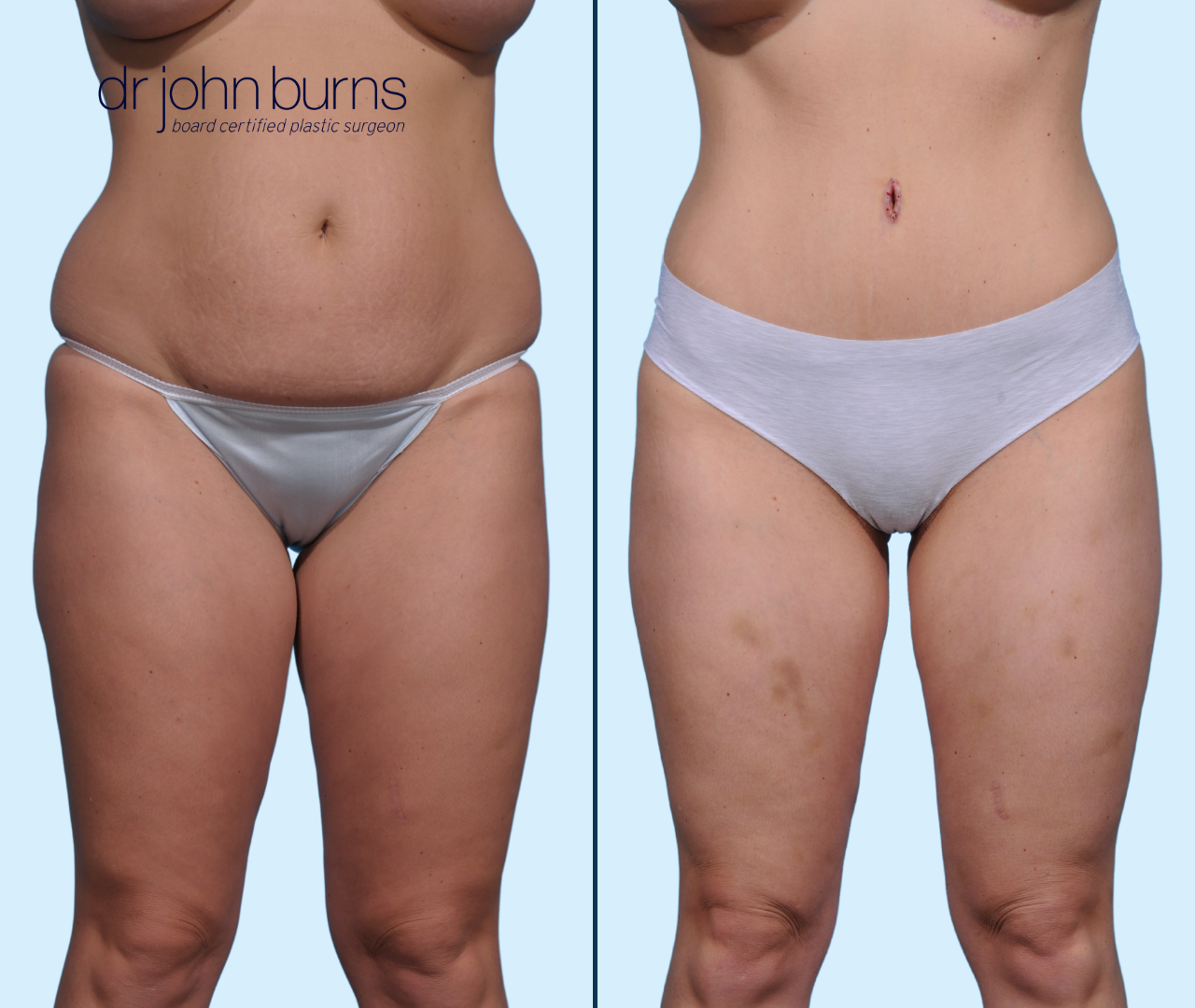 Case 26- Front View- Before & After Full Tummy Tuck with Lipo by Dallas Plastic Surgeon, Dr. John Burns