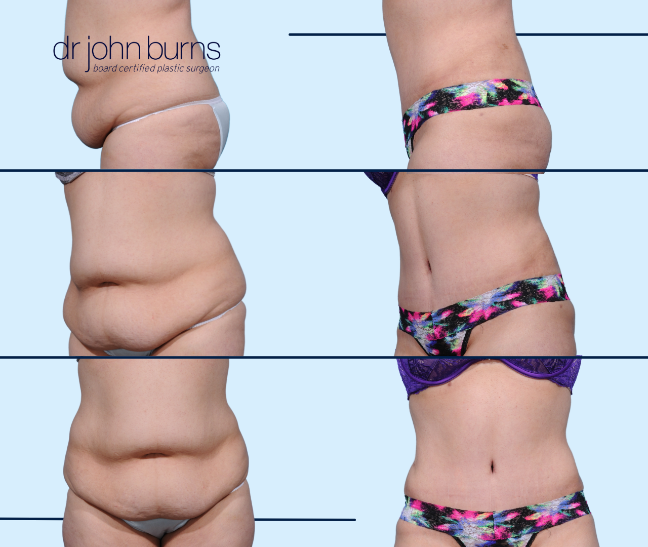 Case 27- Before & After Extended Tummy Tuck with Lipo 360 by Dallas Plastic Surgeon, Dr. John Burns