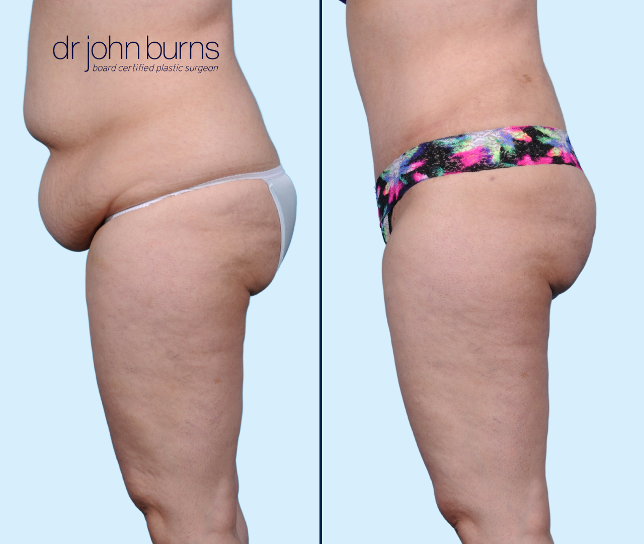 Case 27- Profile View- Before & After Extended Tummy Tuck with Lipo 360 by Dallas Plastic Surgeon, Dr. John Burns