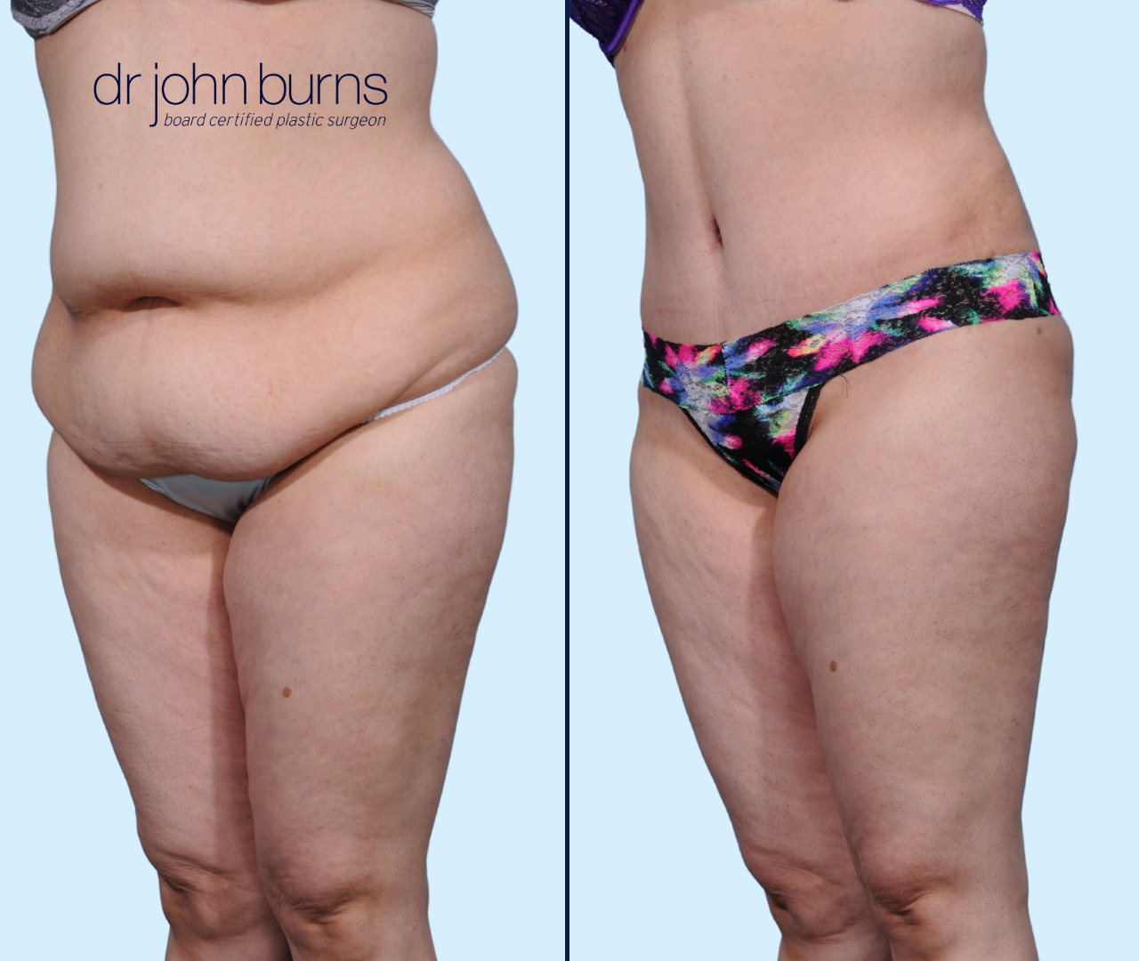 Case 27- 45 Degree View- Before & After Extended Tummy Tuck with Lipo 360 by Dallas Plastic Surgeon, Dr. John Burns