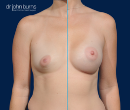 Case 3- Split screen- before and after breast implants by Dallas Plastic Surgeon Dr. John Burns