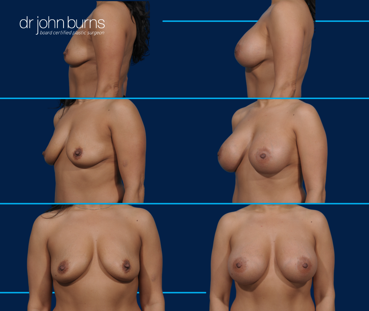 Before and After Breast Augmentation by Dr. John Burns