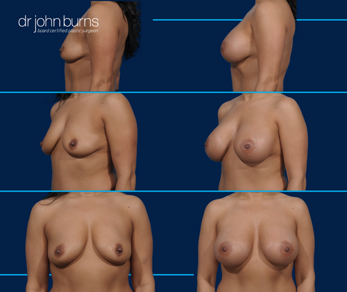 Case 5- Silicone Gel Breast Implant Results by Dr. John Burns, Dallas Texas