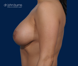 Case 5- Profile View- After Breast Augmentation by Dallas Plastic Surgeon, Dr. John Burns