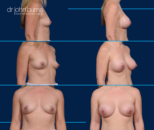 Before and After Breast Implants- Dallas Breast Augmentation- Dr. John Burns