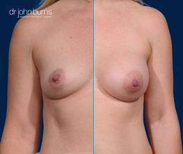 Split screen- Before & After Breast Implants- Dr. John Burns
